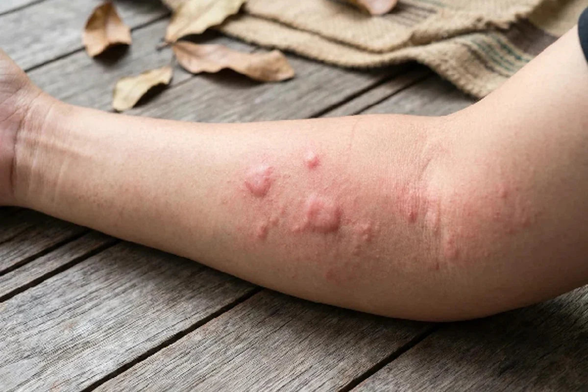 skin welts